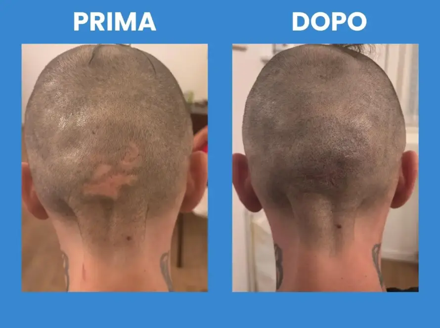 Tricopigmentazione su cicatrici